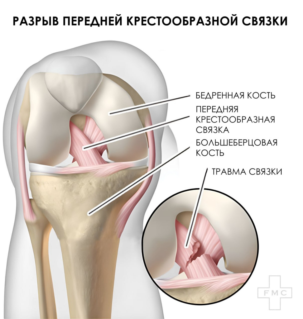 Повреждений коленного сустава